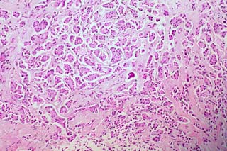 Cancerous Cells in the Breast. Courtesy of Euthman on Flickr.